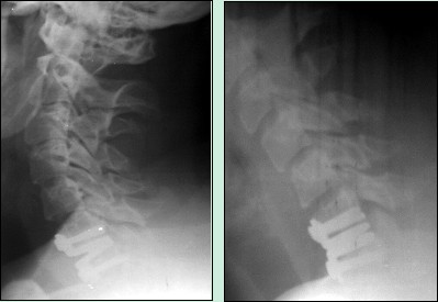 X-ray